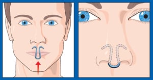 how to use nose dilator