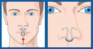 how to stop snoring immediately